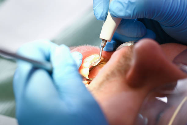 Best Emergency Root Canal Treatment in East Syracuse, NY