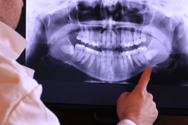 Best Emergency Dentist for Lost Fillings or Crowns in East Syracuse, NY